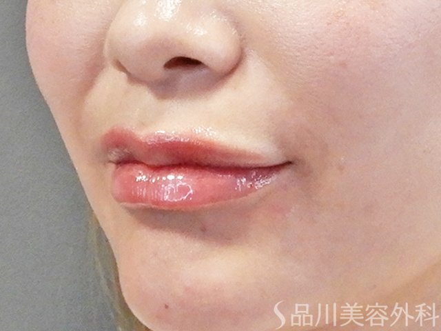 症例NO.67708のAFTER写真