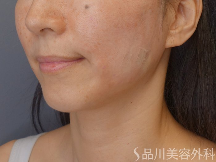 症例NO.72044のAFTER写真