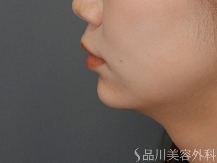 症例NO.63577のAFTER写真