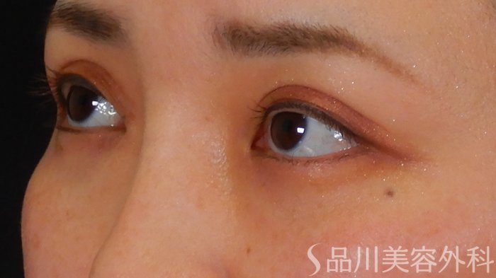症例NO.65697のAFTER写真