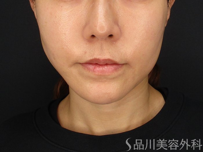 症例NO.69641のAFTER写真