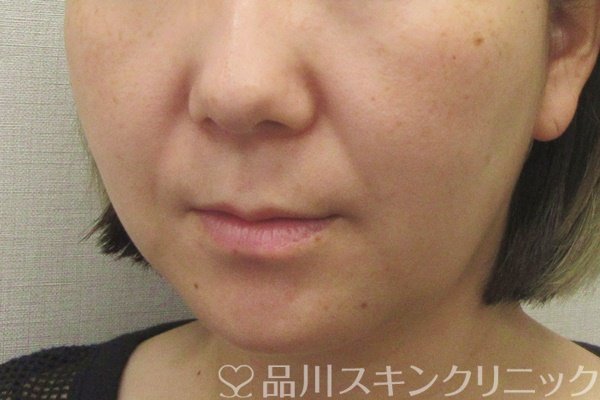 症例NO.70410のBEFORE写真