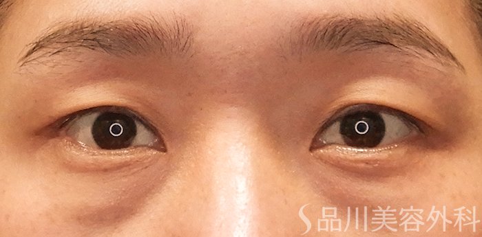 症例NO.69805のBEFORE写真