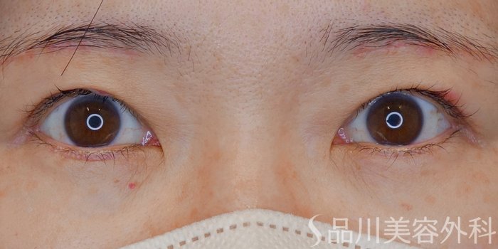 症例NO.70139のBEFORE写真