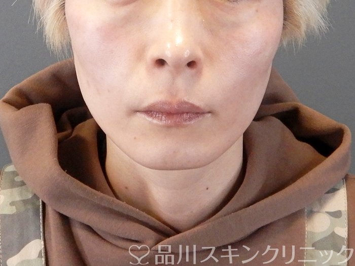 症例NO.63541のAFTER写真