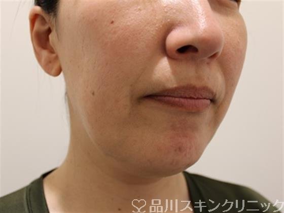 症例NO.45084のBEFORE写真