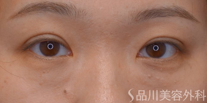 症例NO.74130のAFTER写真