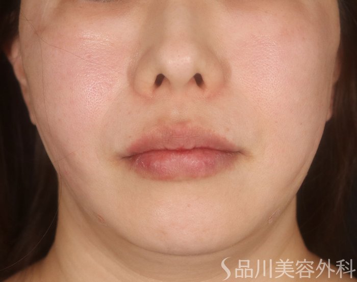 症例NO.73065のAFTER写真