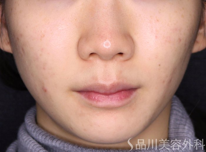 症例NO.73597のAFTER写真