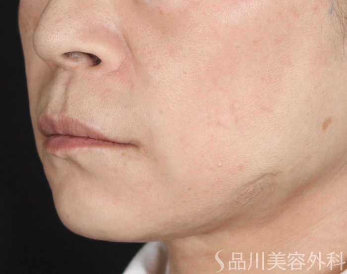 症例NO.72878のAFTER写真