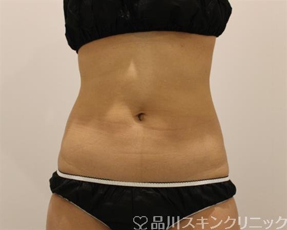 症例NO.50344のAFTER写真