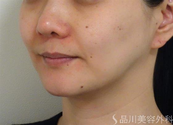 症例NO.40839のBEFORE写真