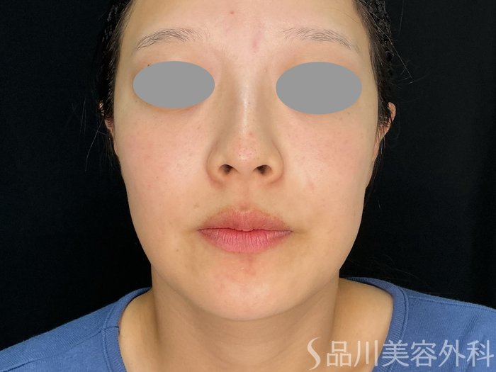 症例NO.72247のBEFORE写真