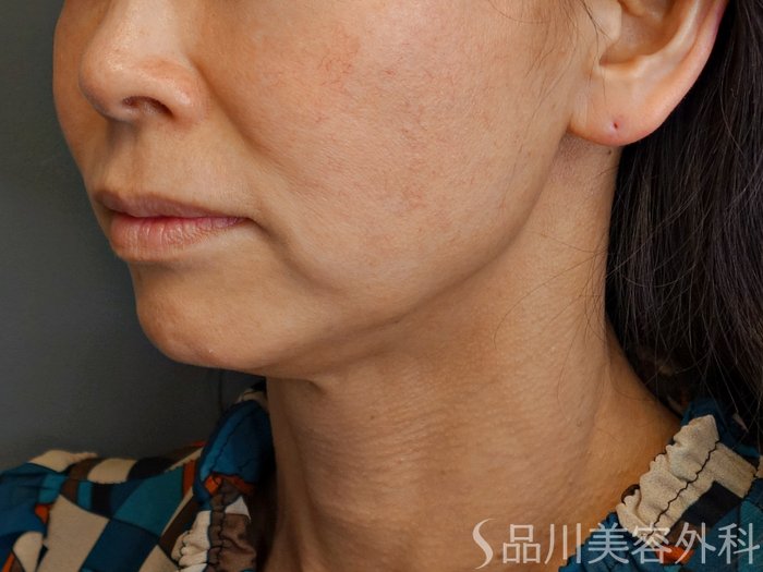 症例NO.72631のBEFORE写真