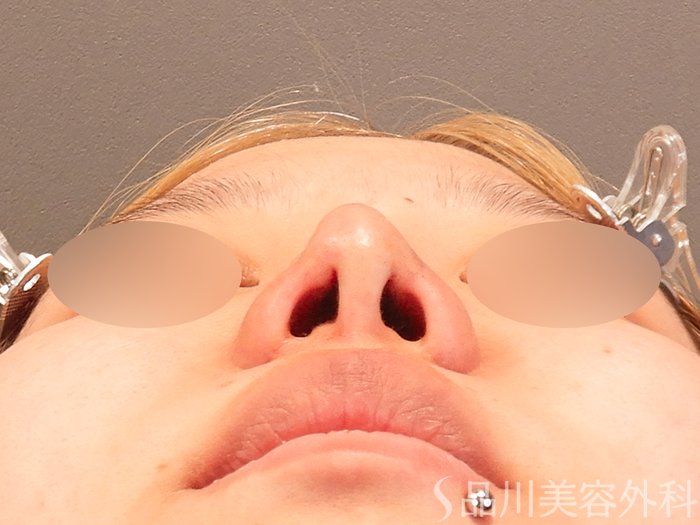 症例NO.70150のAFTER写真