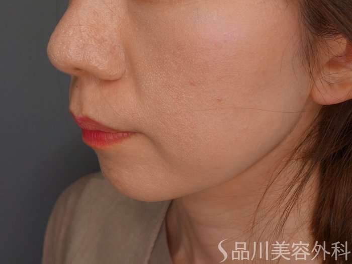 症例NO.74423のBEFORE写真