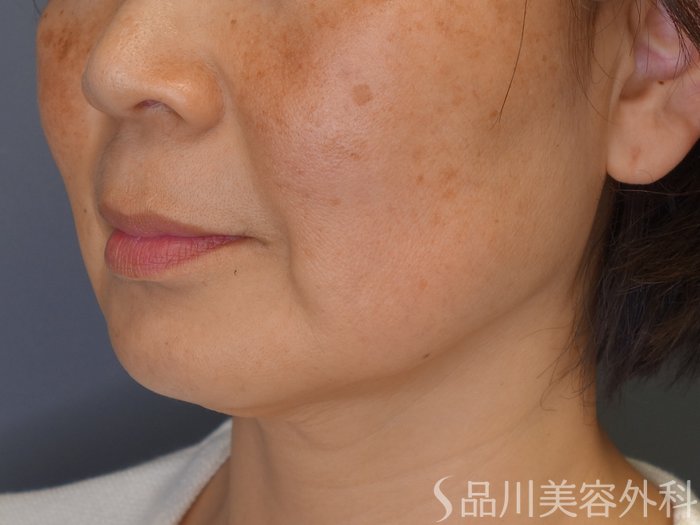 症例NO.68164のBEFORE写真