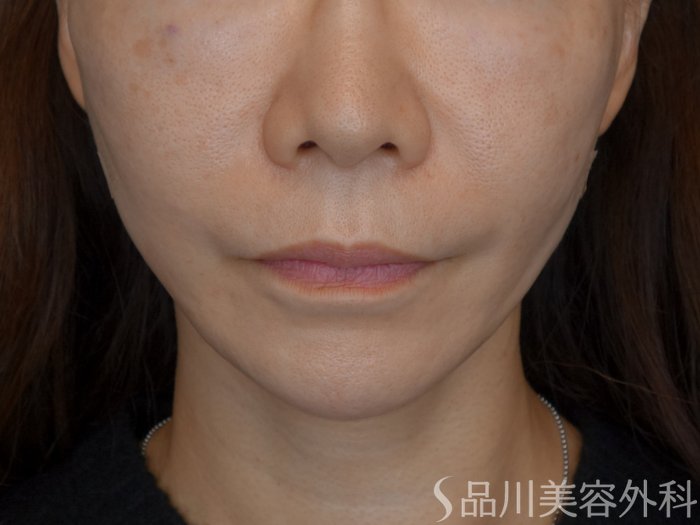 症例NO.72328のAFTER写真