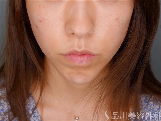 症例NO.51427のAFTER写真