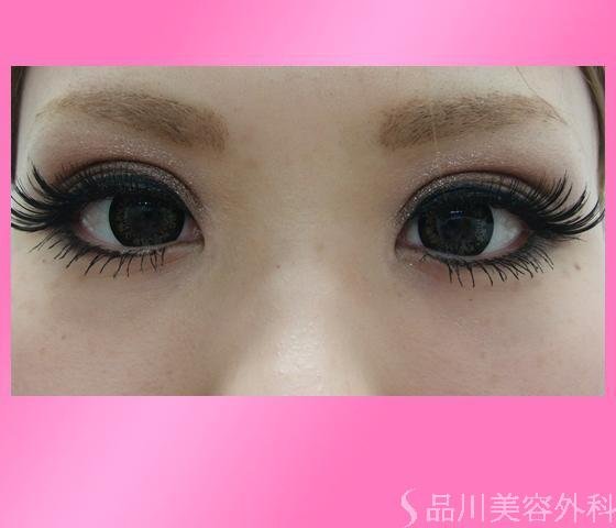 症例NO.2708のAFTER写真