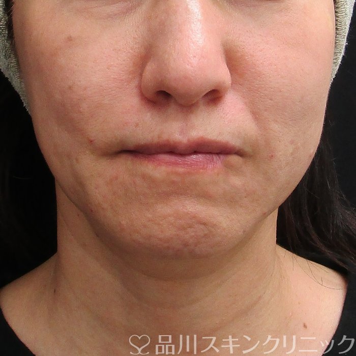 症例NO.74723のAFTER写真