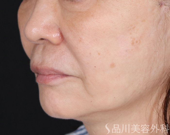 症例NO.71470のBEFORE写真