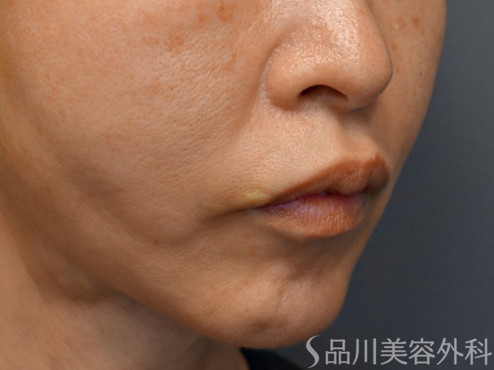 症例NO.71442のBEFORE写真