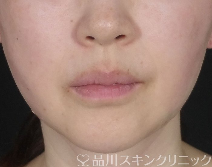 症例NO.68274のAFTER写真
