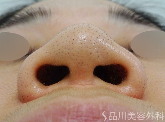 症例NO.69600のBEFORE写真