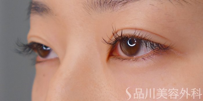 症例NO.70555のBEFORE写真