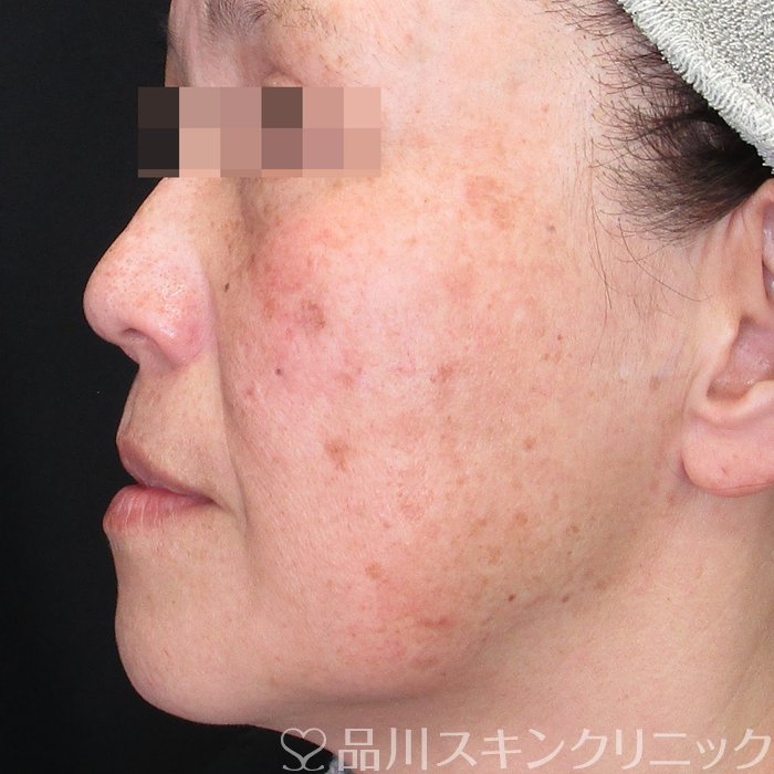 症例NO.74694のBEFORE写真