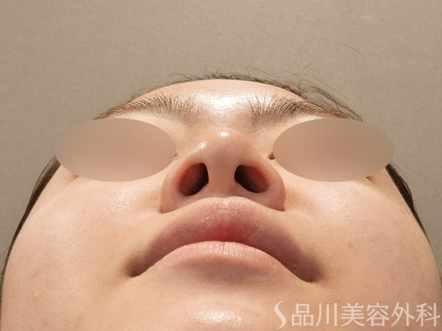 症例NO.75316のBEFORE写真