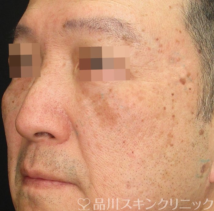 症例NO.73819のBEFORE写真