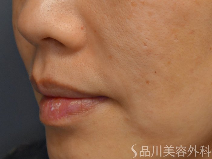 症例NO.67590のBEFORE写真