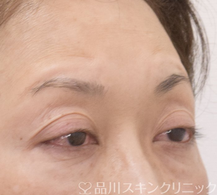 症例NO.74052のBEFORE写真
