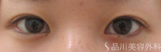 症例NO.21748のBEFORE写真
