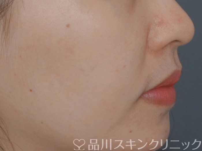 症例NO.73080のAFTER写真