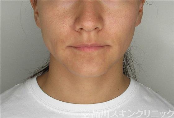 症例NO.61644のBEFORE写真