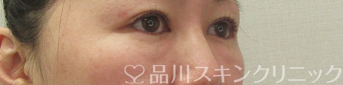 症例NO.71412のBEFORE写真