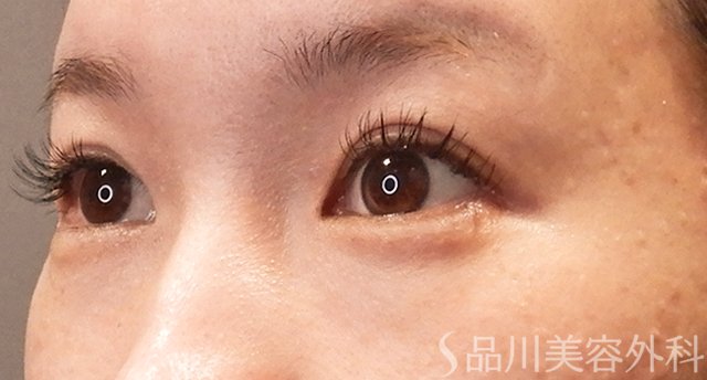 症例NO.70237のBEFORE写真
