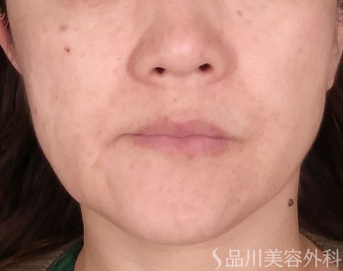 症例NO.70730のBEFORE写真