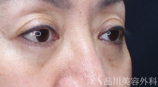 症例NO.71875のAFTER写真