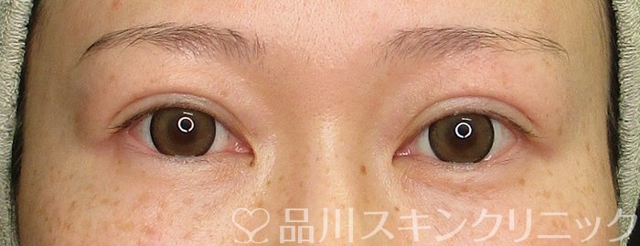 症例NO.70038のAFTER写真