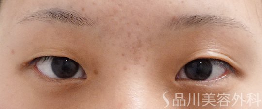 症例NO.62274のBEFORE写真