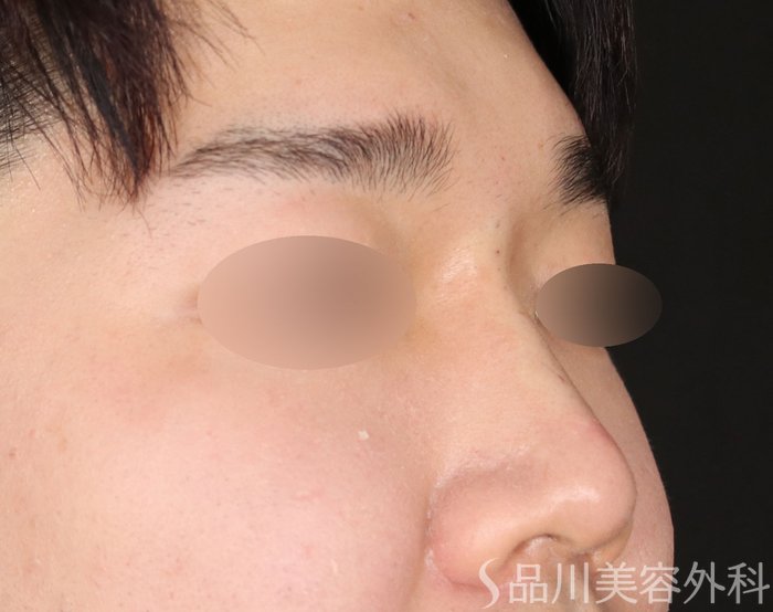 症例NO.72766のAFTER写真