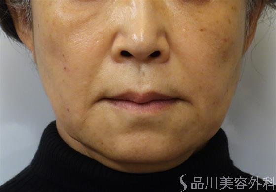 症例NO.40102のBEFORE写真