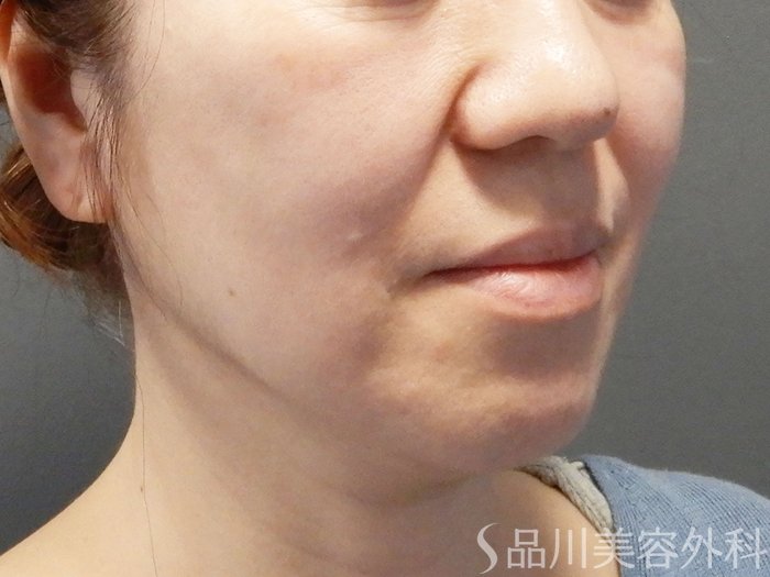 症例NO.75074のBEFORE写真