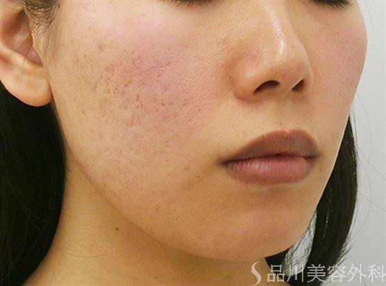 症例NO.24848のBEFORE写真