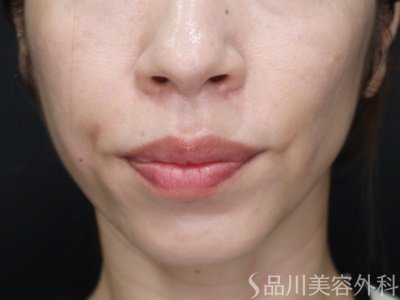 症例NO.72200のAFTER写真