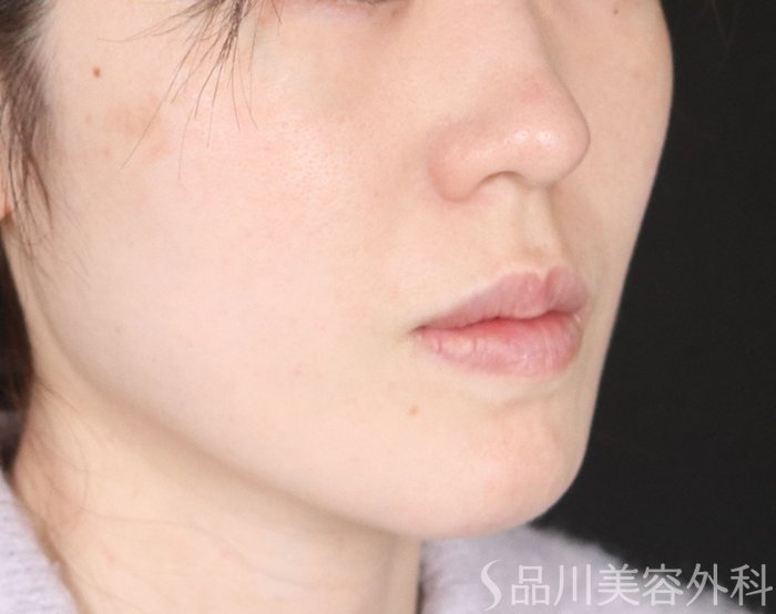 症例NO.73750のAFTER写真